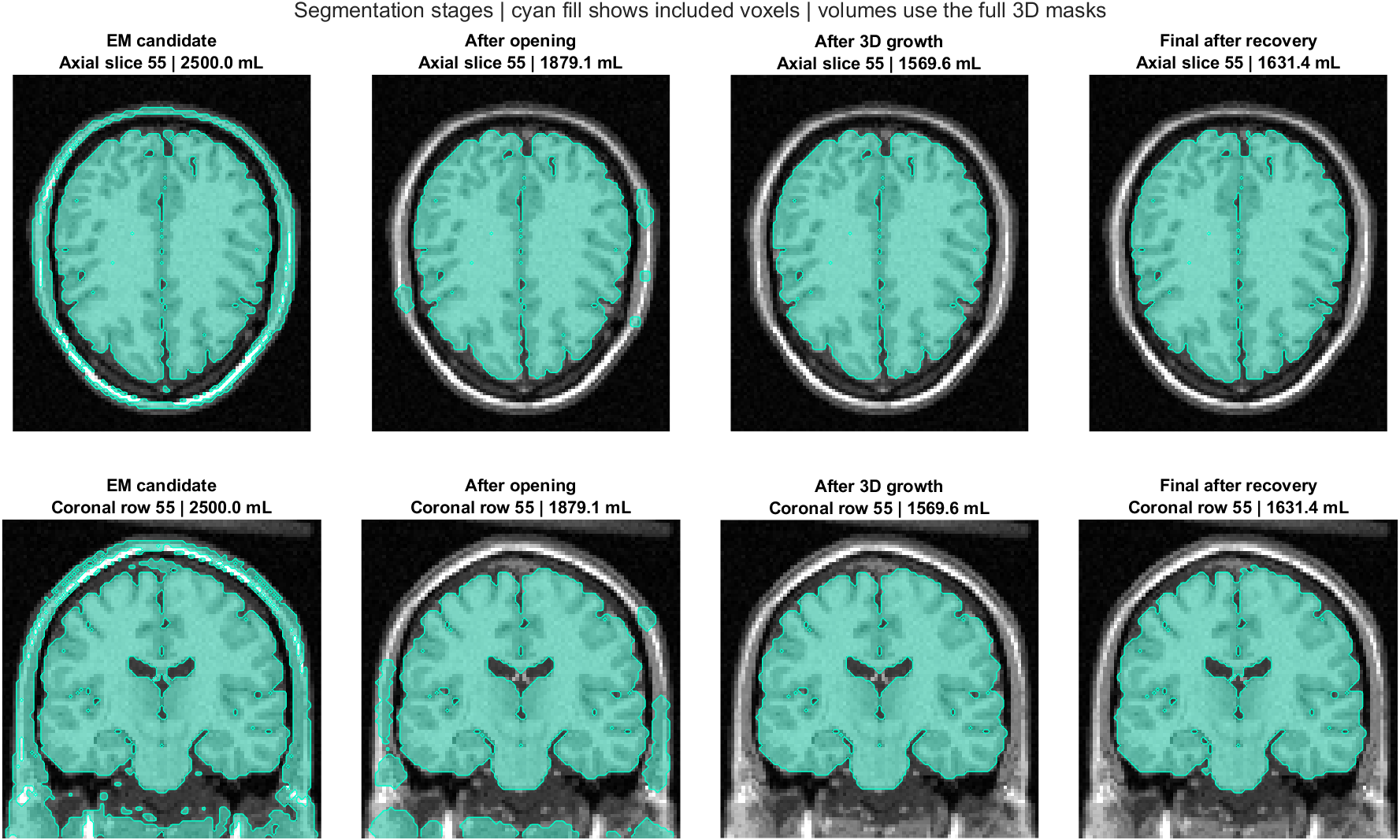 MRI overlays comparing the EM candidate, opening, region growth, and boundary recovery